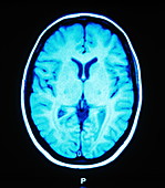 MRI scan of an axial section through the brain