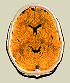 Healthy brain,CT scan