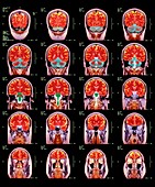 Healthy brain,MRI scans