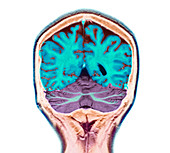 Healthy brain,MRI scan