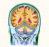 Healthy brain,MRI scan