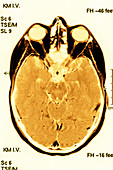 Brain scan,MRI scan