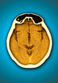 Healthy brain and frontal sinus,CT scan