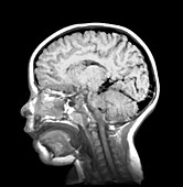 Child's brain,MRI scan