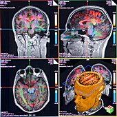 Advanced MRI brain scans