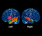 Brain hearing activity,PET scan