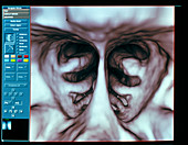 3-D CT scan of the conchae in the nasal sinuses