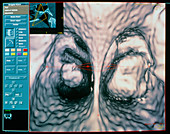 3-D CT scan of the conchae in the nasal sinuses