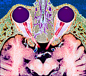 Vision and the brain,MRI scan