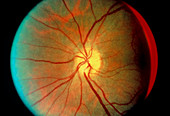 Fundus camera image of a normal,healthy retina