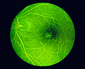 Fluorescein angiogram of a healthy eye retina