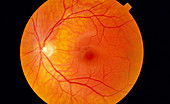 Healthy retina