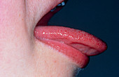 Normal tongue: profile view