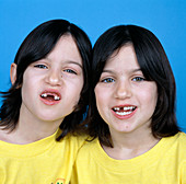 Loss of milk teeth