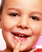 Loss of milk teeth