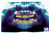 Emergence of adult teeth,X-ray