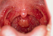 Close-up of lymphoid tissue on the throat of a boy