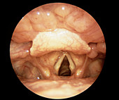 Vocal cords