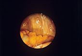 Colon and peritoneum,laparoscope view