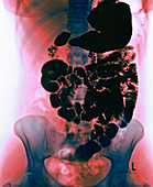 Normal digestive system,barium X-ray