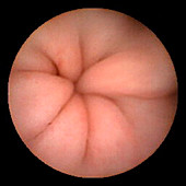 Pyloric sphincter,pill camera view