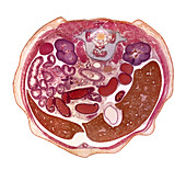 Foetal abdomen