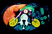 Coloured CT scan of healthy kidneys in abdomen