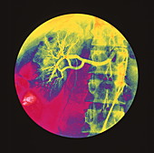 Coloured angiogram X-ray of a healthy kidney
