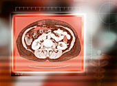 Healthy kidneys,CT scan