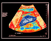 Healthy kidney measured,ultrasound scan