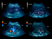 Healthy kidneys,ultrasound scan