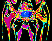 Coloured MRI scan of human pelvis and bladder
