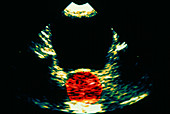 Colour ultrasound image of bladder and prostate