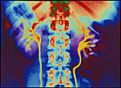 Coloured urogram X-ray of healthy human ureters