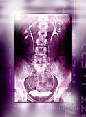 Urinary tract,X-ray