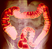 Large intestine,X-ray