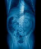 Normal large intestine,CT scan