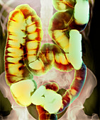 Healthy large intestine,barium X-ray