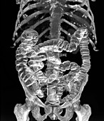 Normal intestines,3D CT scan