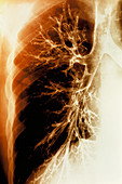 Lung airways,coloured X-ray