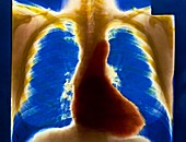 Chest X-ray of normal heart and lungs