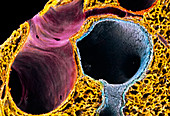 Coloured SEM of lung showing alveoli and bronchus