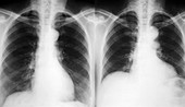 Breathing,X-ray