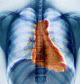 Breathing,X-ray