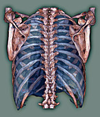 Lungs and thorax bones,3D CT scan