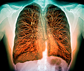 Lungs,3D MRI scan