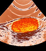 Human testis,ultrasound scan