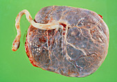 Gross specimen of normal placenta