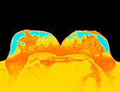 Coloured MRI scan of healthy breasts of a woman