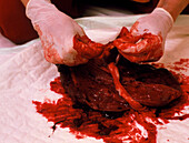 Gloved hands examine a healthy placenta